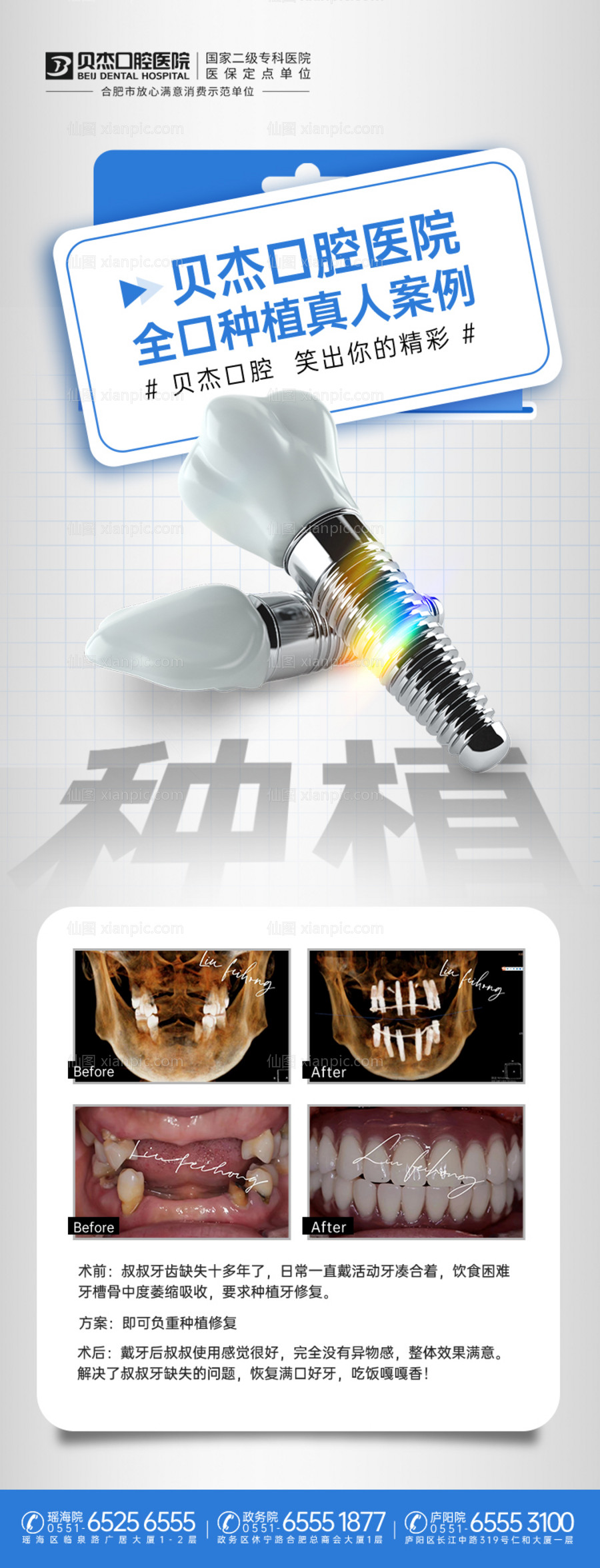 素材乐-口腔种植牙案例