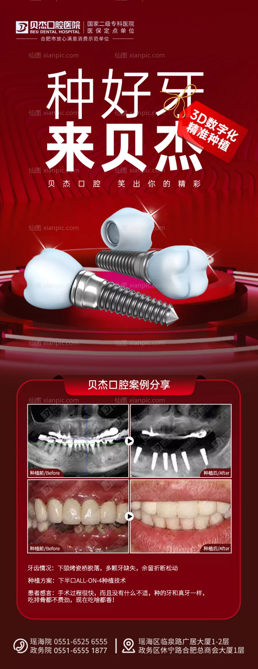 仙图网-口腔种植牙案例