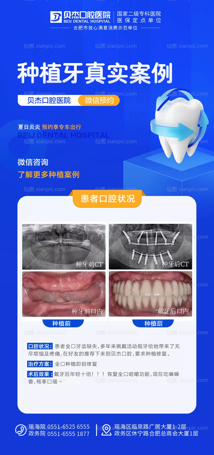 仙图网-种植牙案例