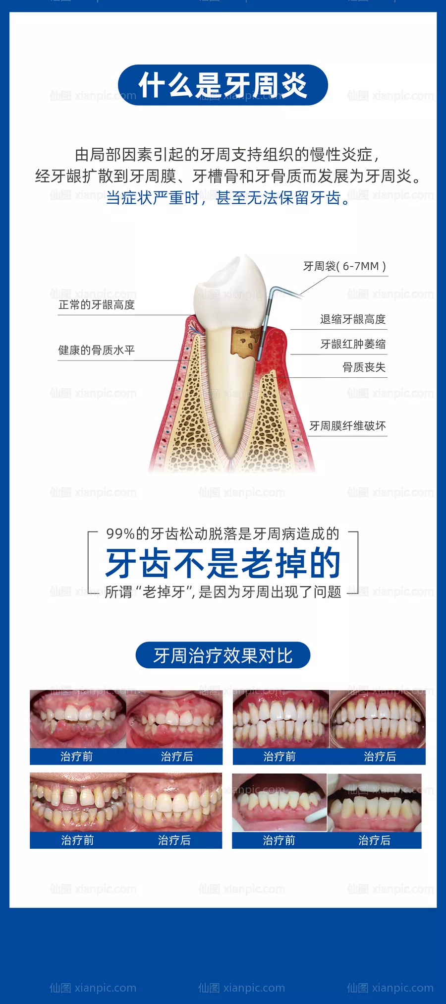 仙图网-牙周炎易拉宝