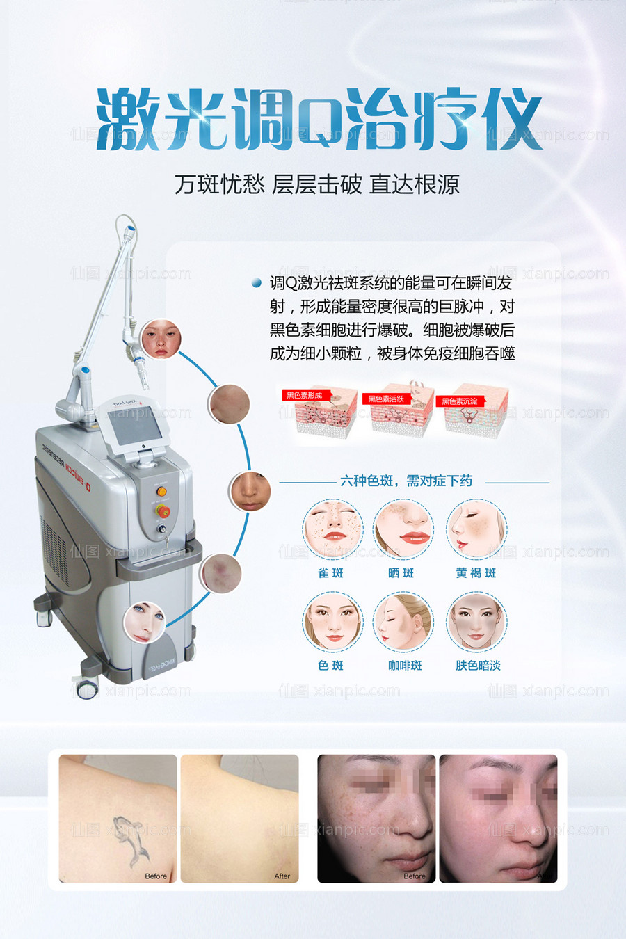 仙图网-激光调Q治疗仪