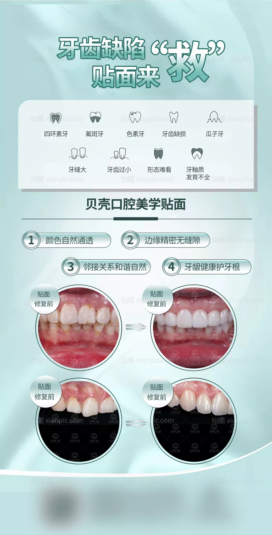 仙图网-牙齿贴面