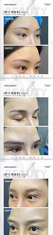 仙图网-眉弓医美案例