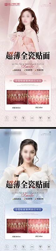 仙图网-口腔牙齿贴面案例